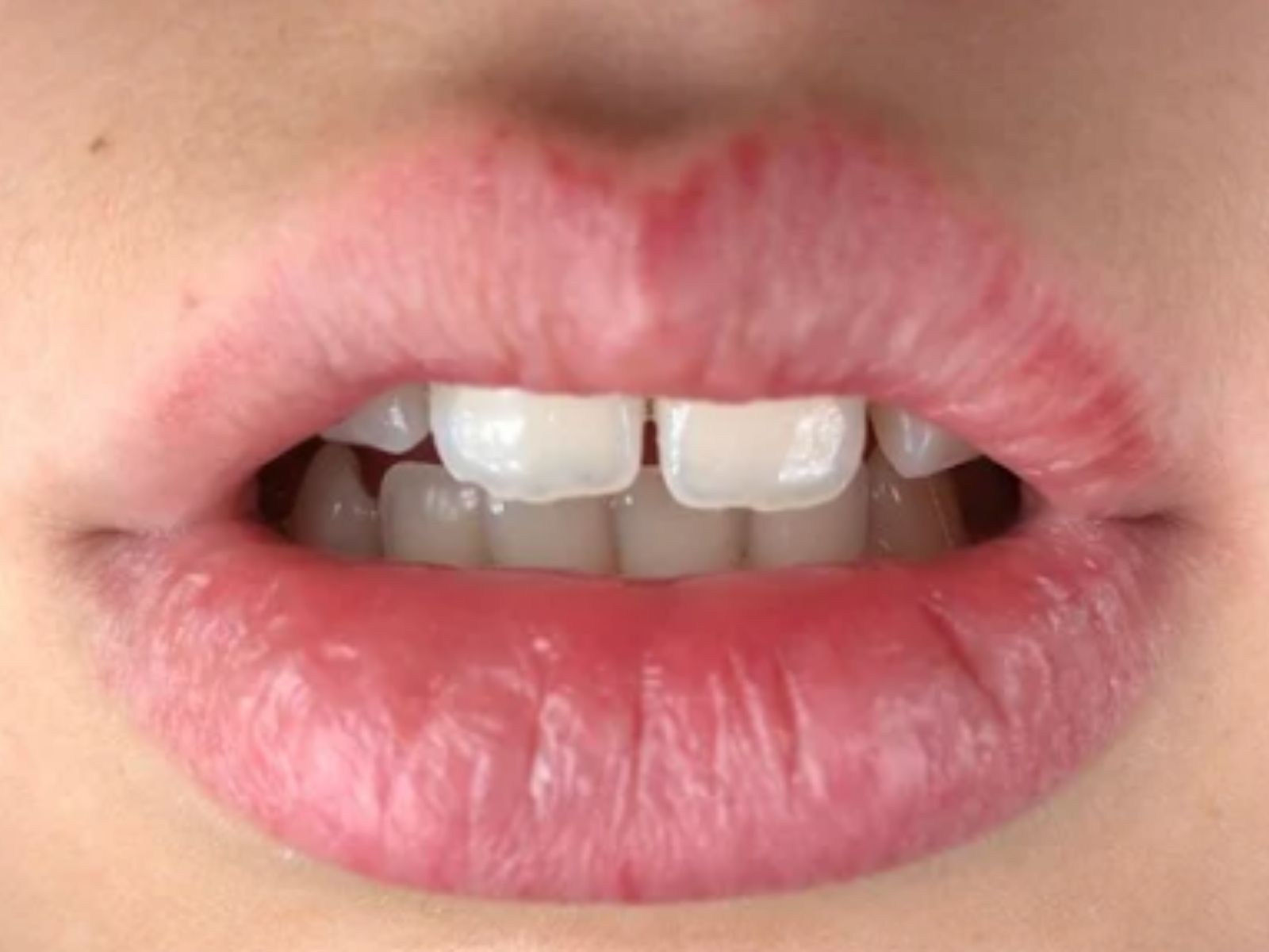 mouth breathing and bedwetting brookfiled